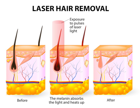 laser_hair_removal.jpg